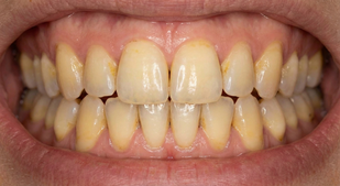 yellow, stained teeth