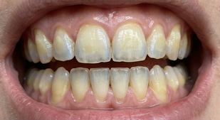 weak, sensitive enamel